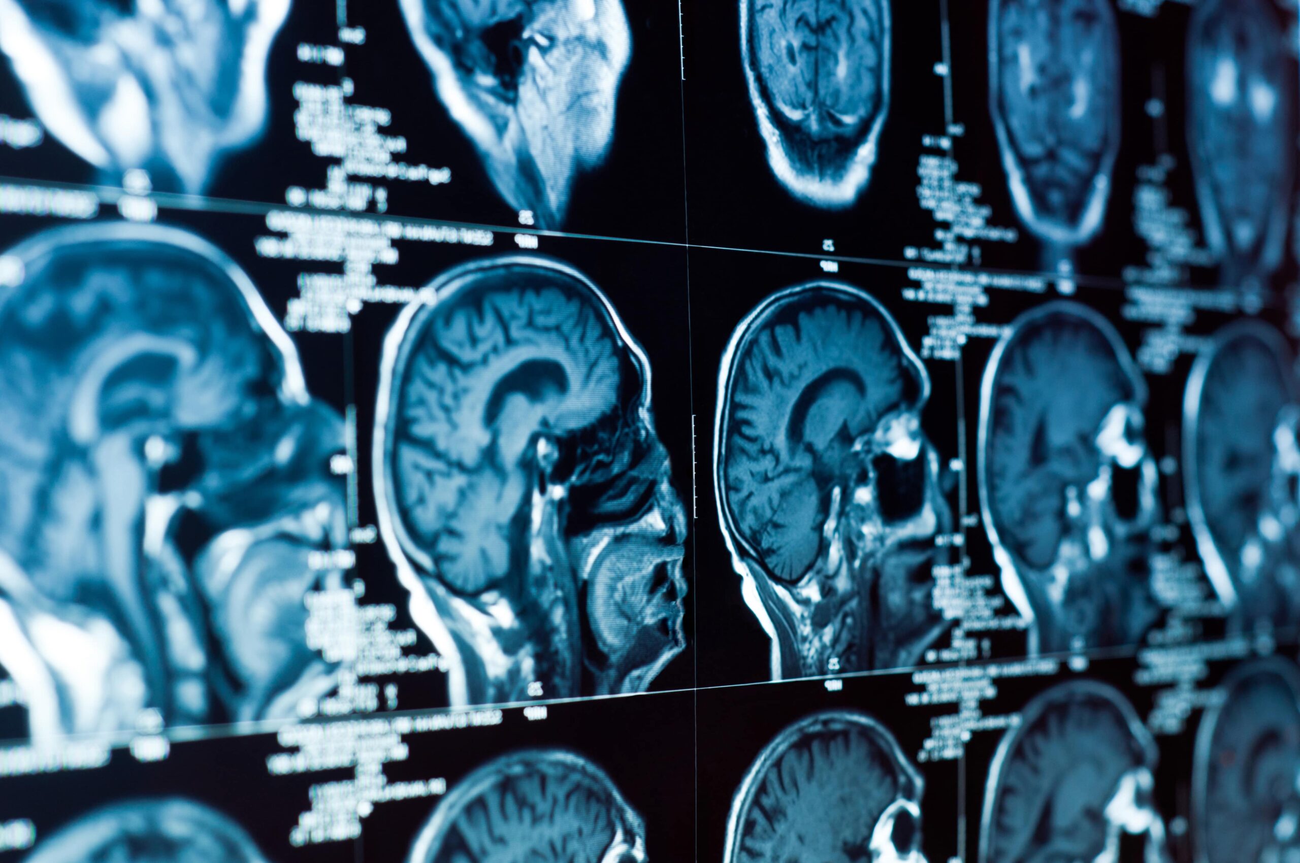 Common Causes of Brain Injuries in New Haven, CT