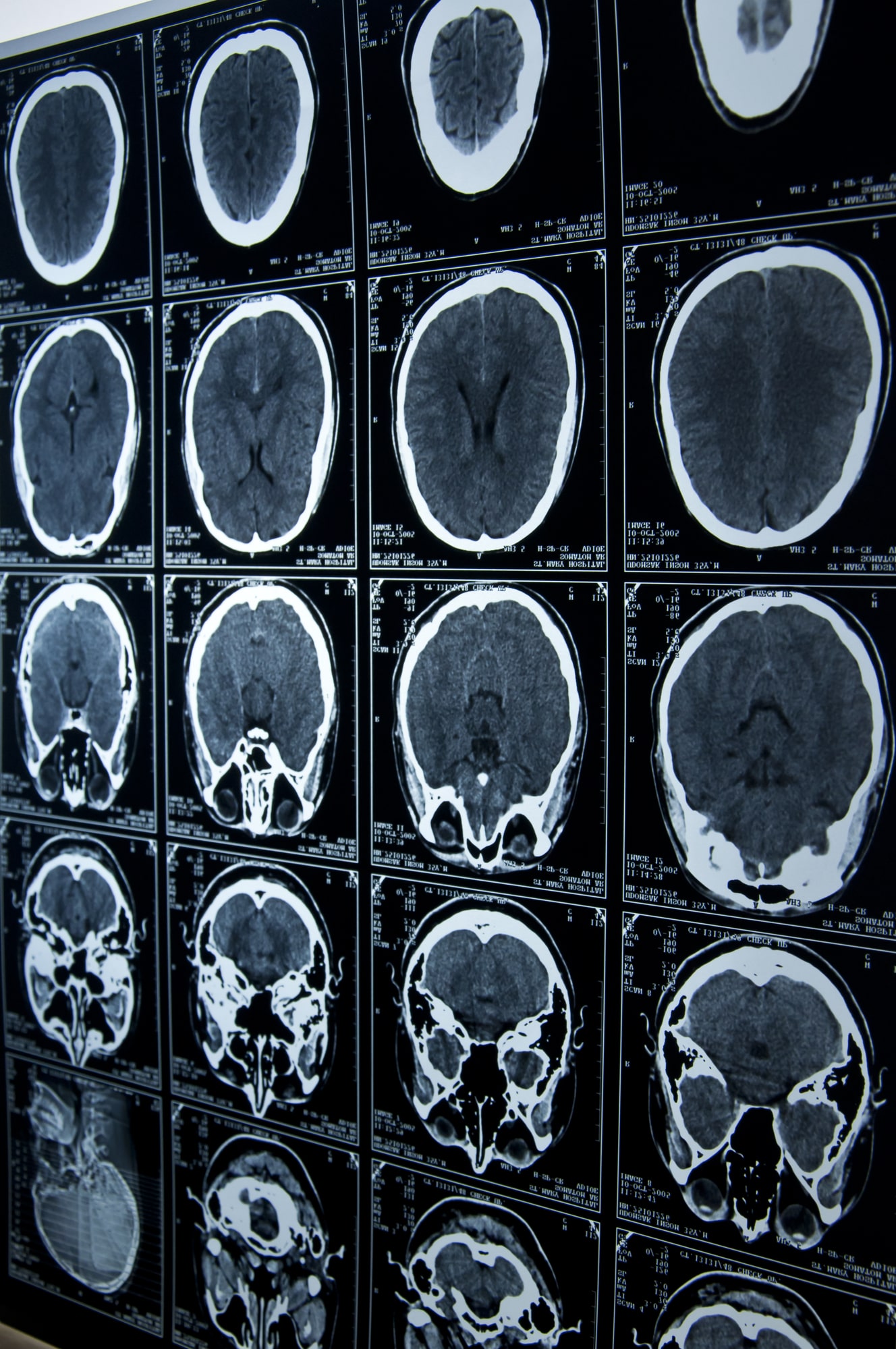 brain injury lawyer New Haven, CT