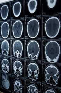 catastrophic injury lawyer in Hartford, CT